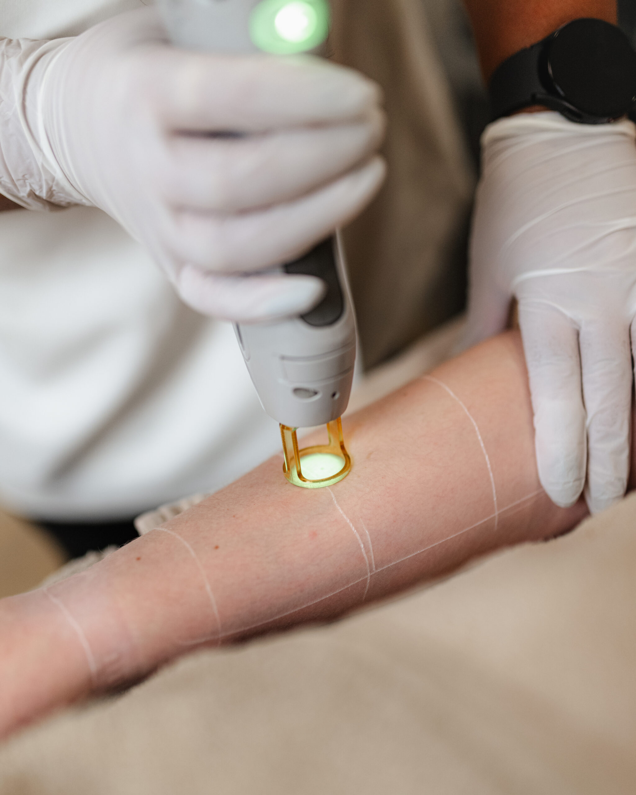 Huidtherapeut NOVA Huidkliniek laserontharen